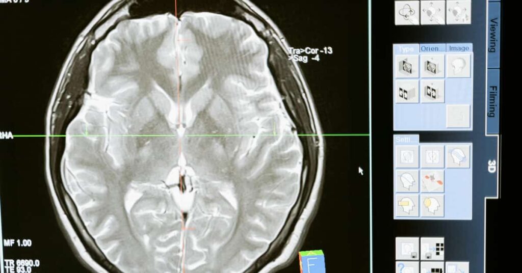 Brain haemorrhage recovery time Brain haemorrhage recovery time